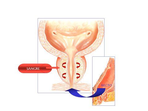 Prostatitis crónica