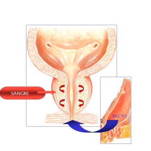 Prostatitis crónica