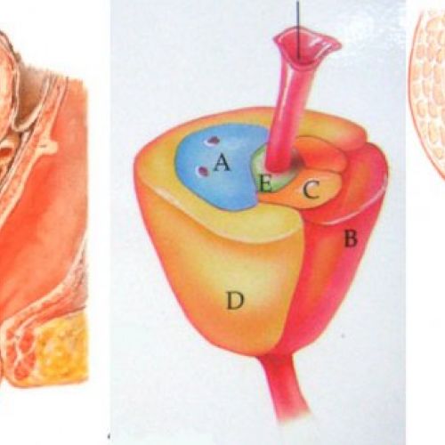 hiperplasia prostática benigna