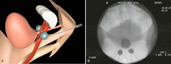 Balones implantables