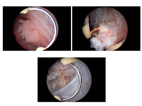 Tumores vesicales superficiales