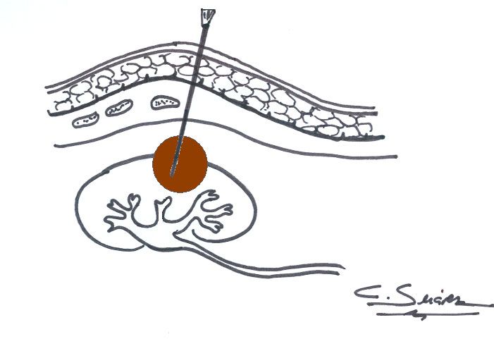 BAG o biopsia