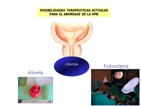 cirugía abierta o endoscópica