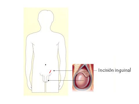 Orquiectomia radical